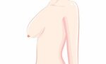 Brustkorrektur einer asymmetrischen oder tubulären Brust - P